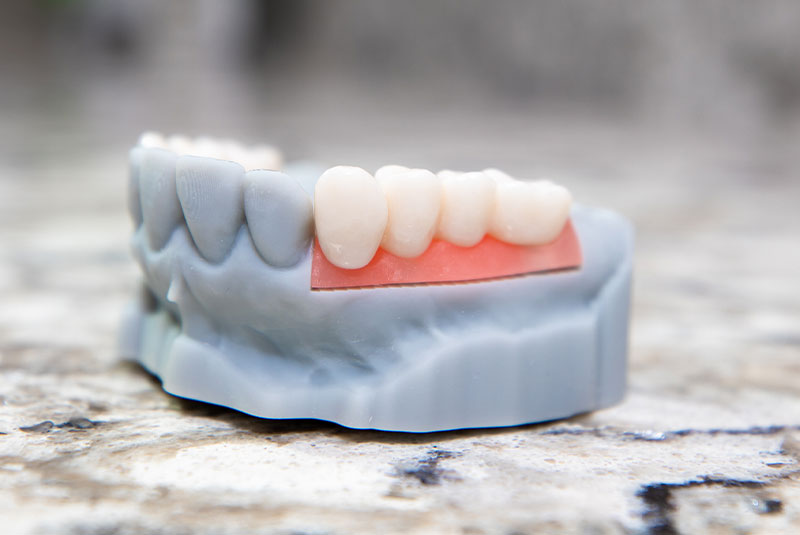 Dental Implants Lexington, KY iDENTity Dental Studio