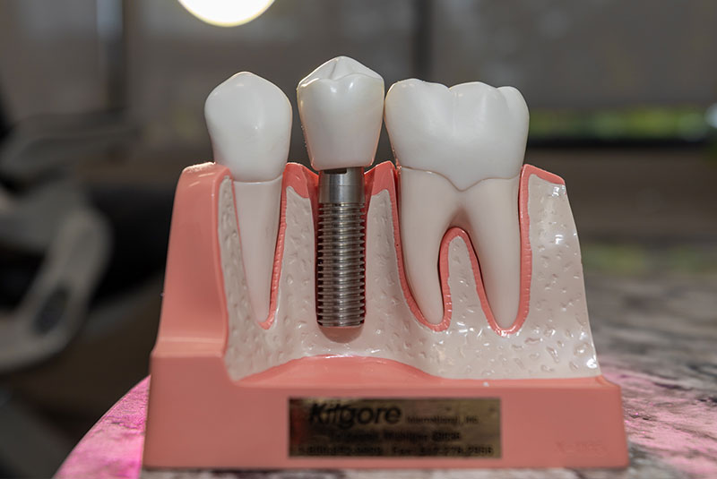 Dental Implants Lexington, KY iDENTity Dental Studio