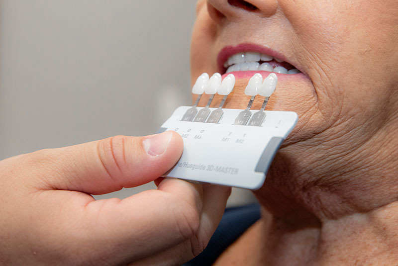 porcelain veneers