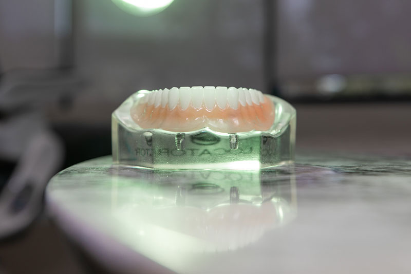 implants supported dentures